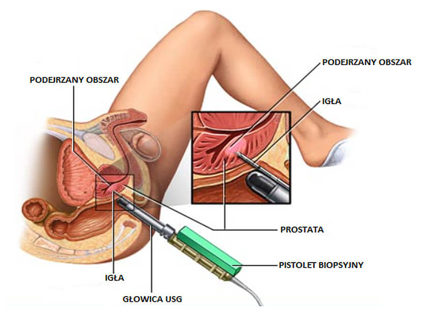 Biopsja Prostaty - Sonomed Szczecin