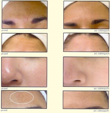 HydraFacial, hydradermabrazja, dermabrazja