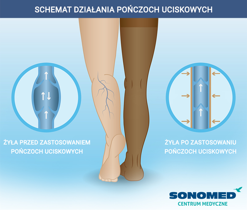 działanie pończoch uciskowych, pończochy uciskowe, rajstopy uciskowe, choroby żył, leczenie chorób żył, flebologia, żylaki, leczenie żylaków, profilaktyka żylaków