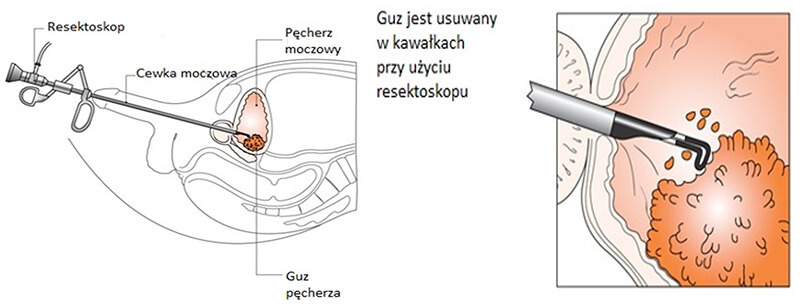 TURBT- elektroresekcja przezcewkowa guza pęcherza moczowego