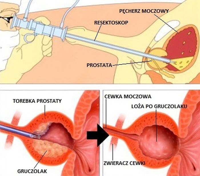 Przezcewkowa  elektroresekcja stercza – TURP (ang. Transurethral resection of the prostate)